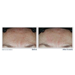 Before and After image of study participant forehead showing visibly smoother skin on forehead after 8 weeks of use of MULTI CORREXION® Hydrate + Plump Moisturizer with SPF 30