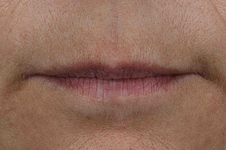 Customer lips before using the Derm Correxion Lip Volumizer