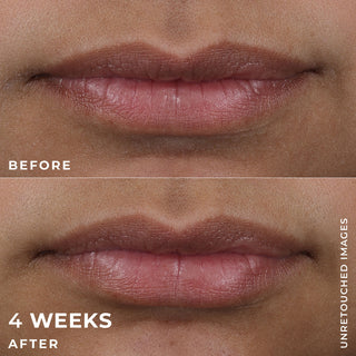 Before and after 4 weeks of clients lips