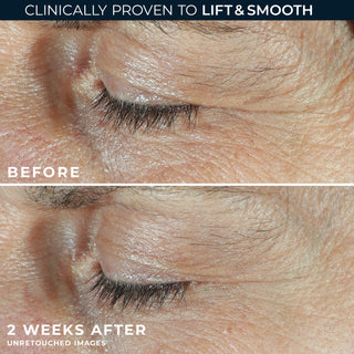 Before and after photo
clinically proven to lift & smooth
Before
2 weeks after unretouched images