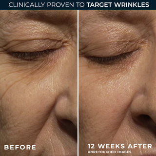 before and after photos
clinicially proven to target wrinkles
before
12 weeks after unretouched images