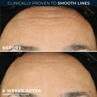 before and after photos
clinically proven to smooth lines