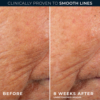 before and after photos
clinically proven to smooth lines